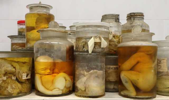 Organi malati e feti malformati: nel Policlinico potrebbe nascere il "museo del materiale anatomico"